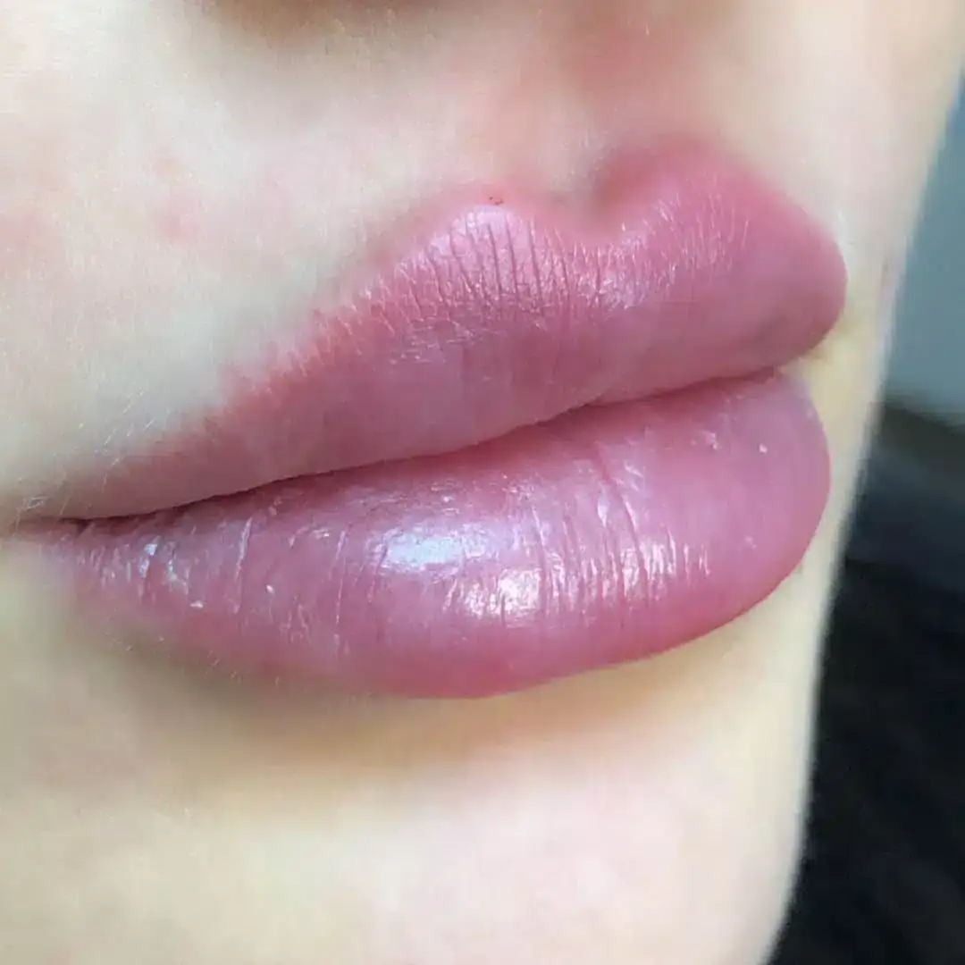 Lippen aufspritzen Ergebnis 3 – Patientin mit natürlich vollen Lippen