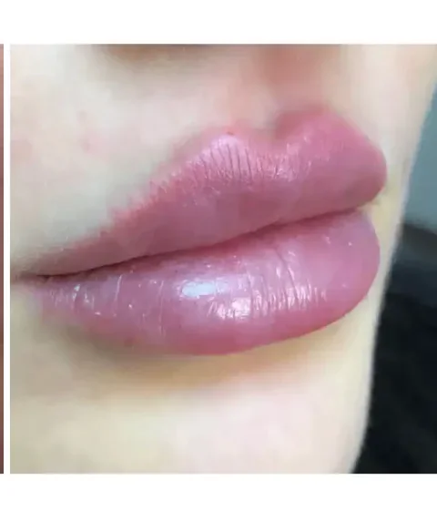 Lippen aufspritzen Ergebnis 4 – Patientin mit natürlich vollen Lippen