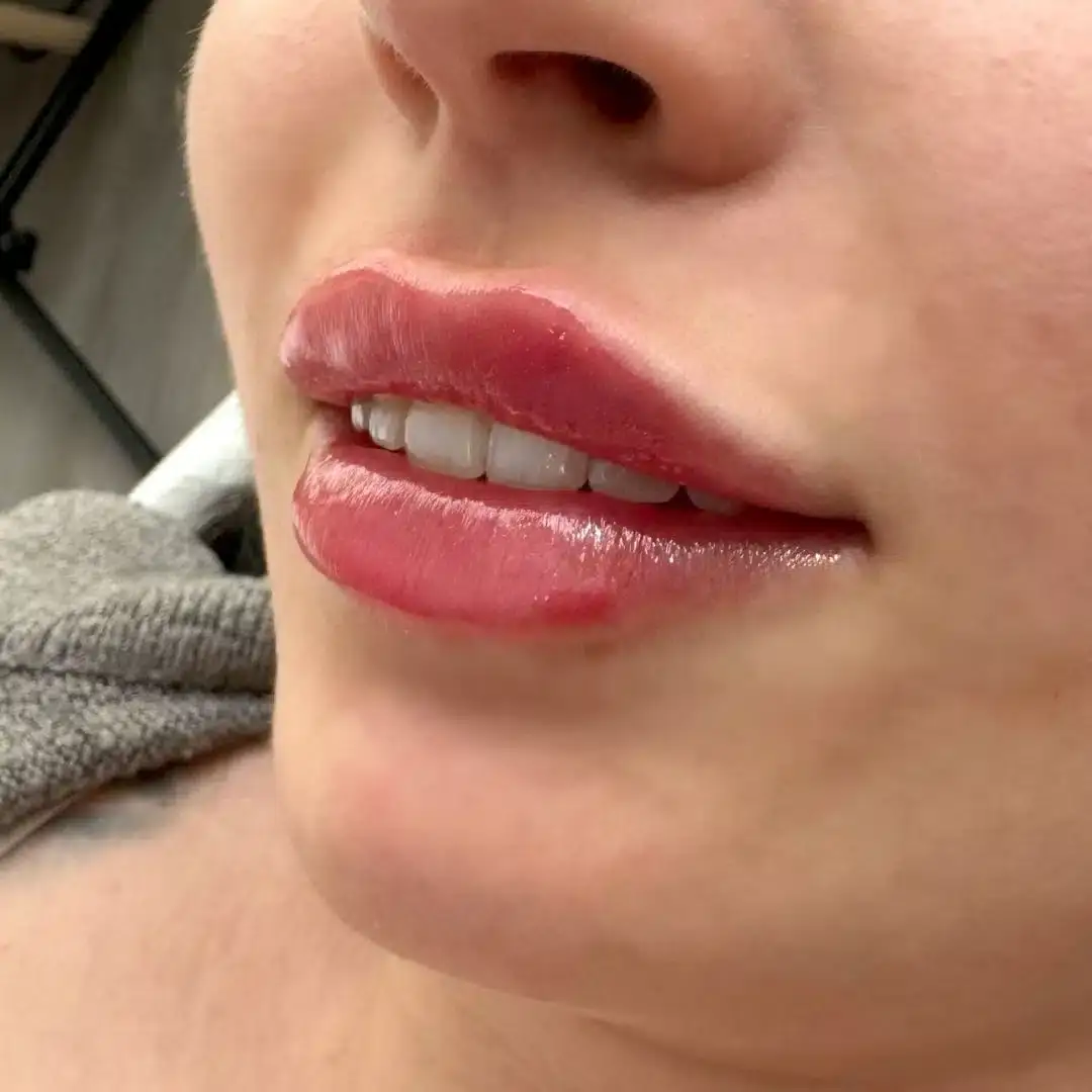 Lippen aufspritzen Ergebnis 6 – Patientin mit natürlich vollen Lippen