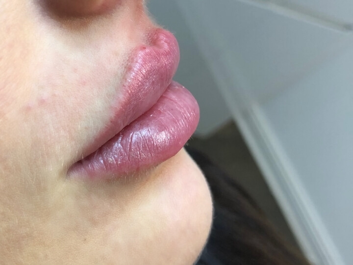 Das Foto zeigt eine Lippenunterspritzung für Russian Lips.