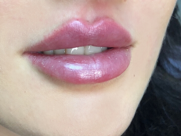Das Bild zeigt eine Frau mit Russian Lips (Doll Lips) und verdeutlicht den Effekt einer modernen Lippenvergrößerung.