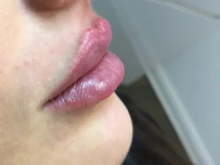 Das Foto zeigt eine Lippenvergrößerung mit Russian Lips Technik.