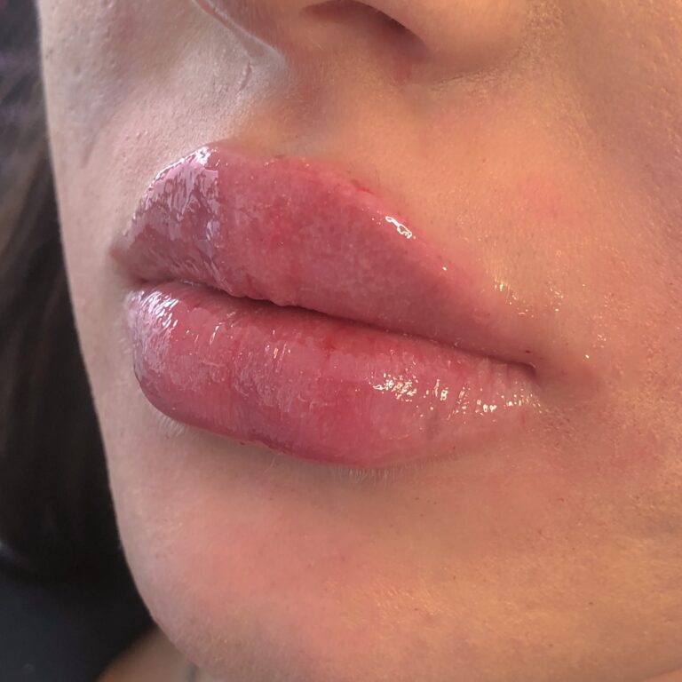 Das Bild zeigt eine Oberlippe nach der Lip Flip Vergrößerung mit Muskelrelaxans.