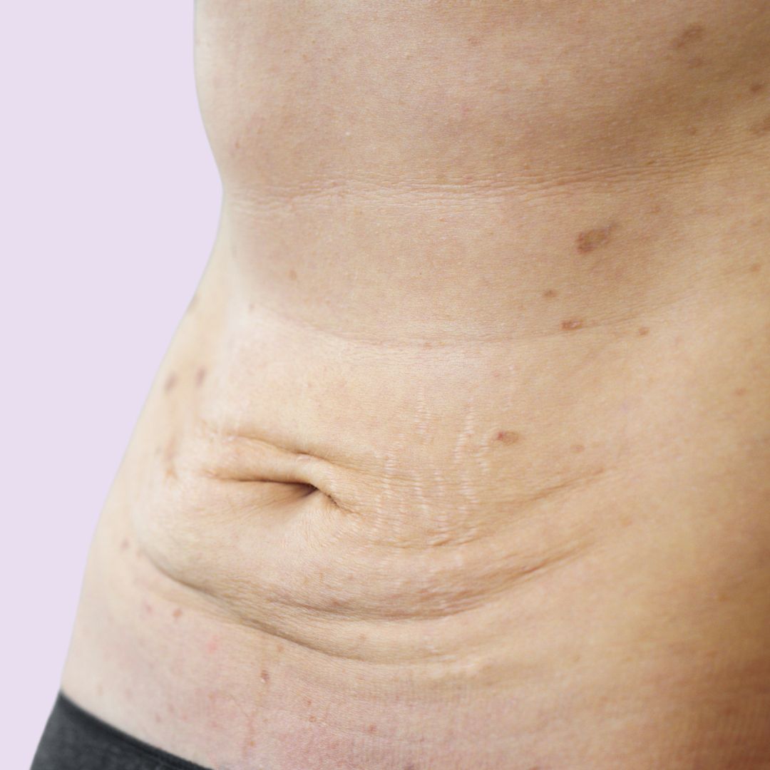 Das Foto zeigt erschlaffte Bauchhaut und dient der Verdeutlichung des Themas: »Bauchdeckenstraffung«.